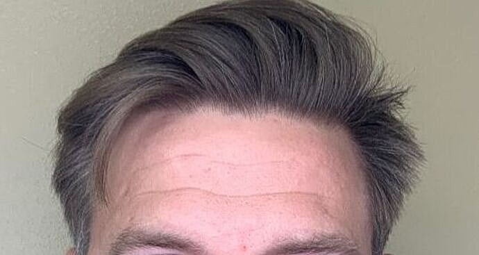Botox Before & After