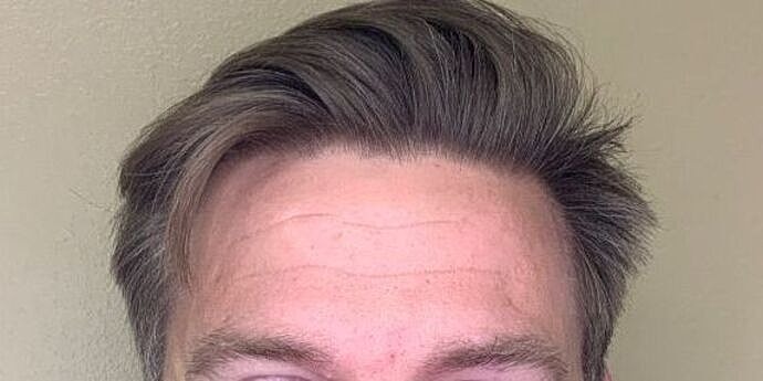 Botox Before & After