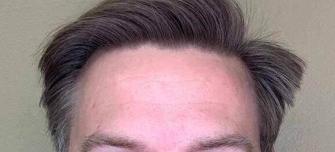 Botox Before & After