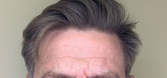 Botox Before & After
