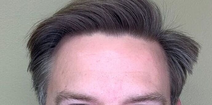 Botox Before & After