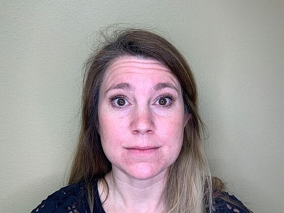 Botox Before & After