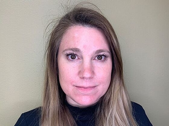 Botox Before & After