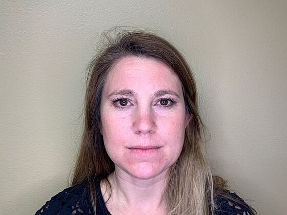 Botox Before & After