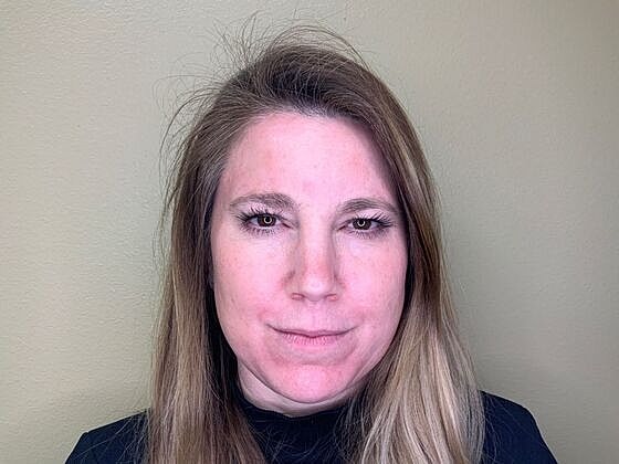 Botox Before & After