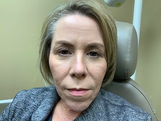 Botox Before & After