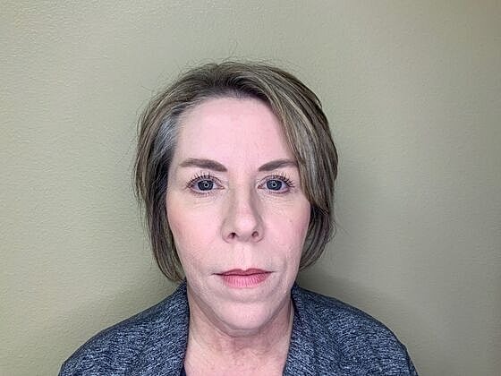 Botox Before & After