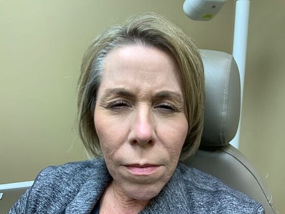 Botox Before & After