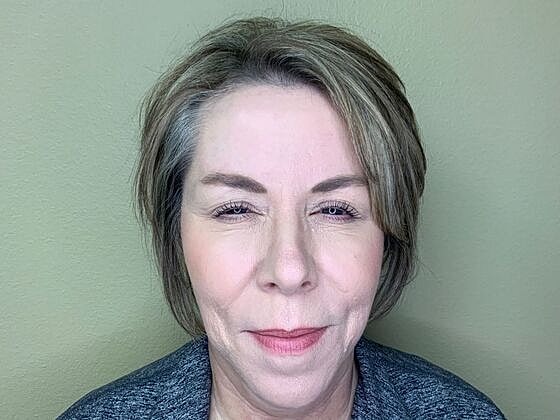 Botox Before & After