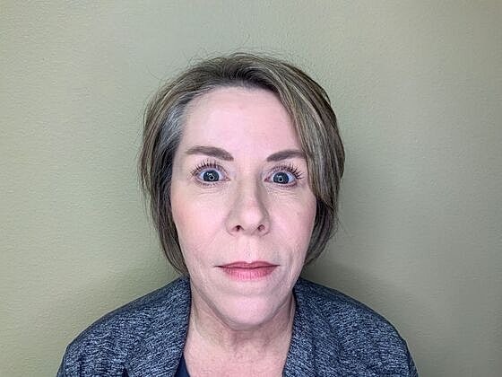 Botox Before & After