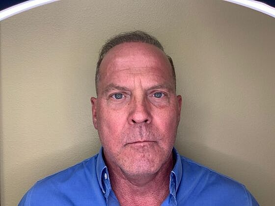 Botox Before & After