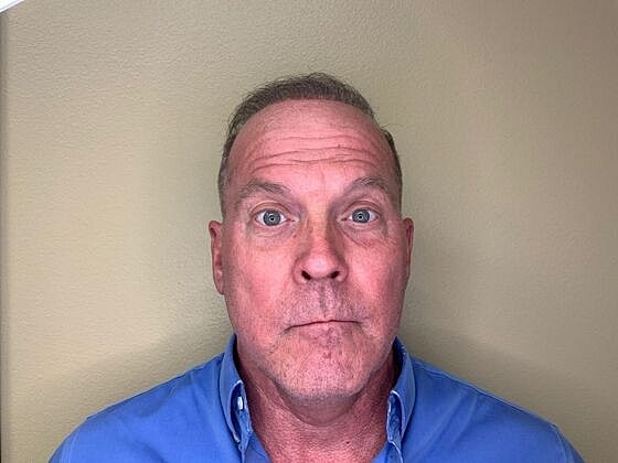 Botox Before & After