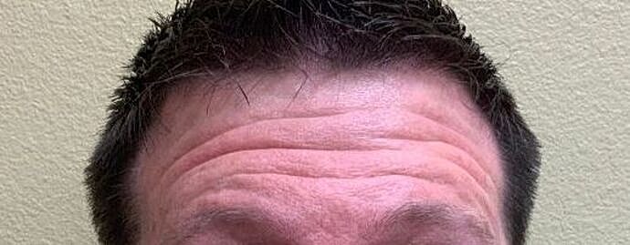 Botox Before & After