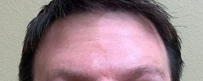 Botox Before & After