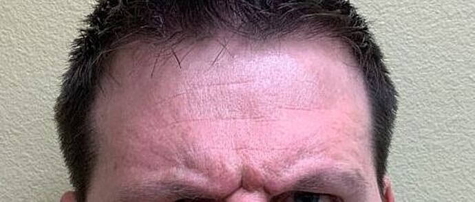 Botox Before & After