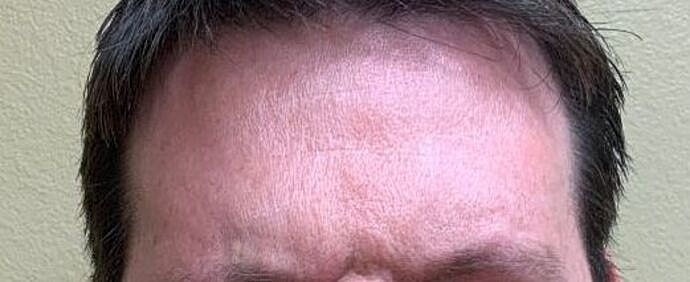 Botox Before & After