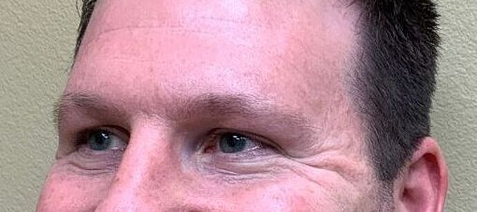 Botox Before & After