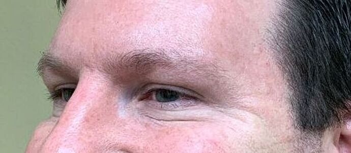 Botox Before & After