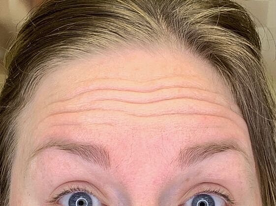 Botox Before & After