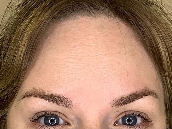 Botox Before & After