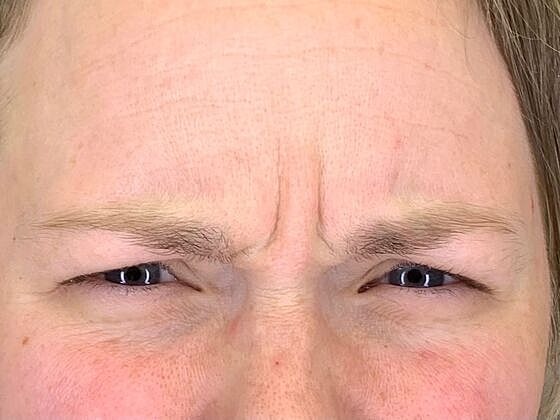 Botox Before & After