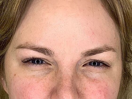 Botox Before & After