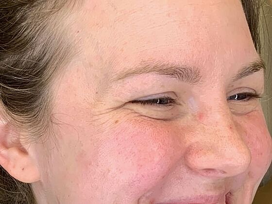 Botox Before & After
