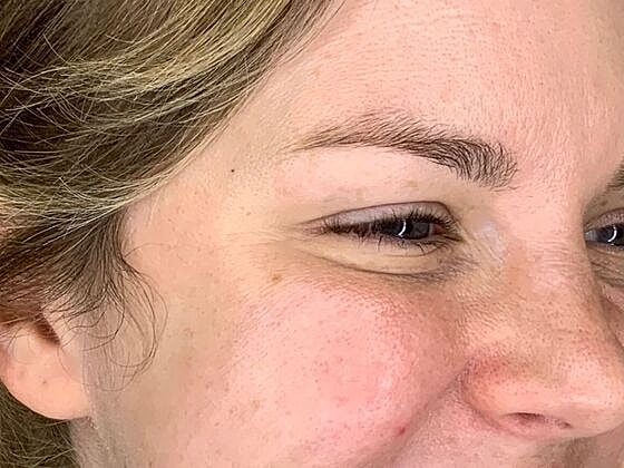 Botox Before & After