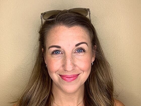 Botox Before & After