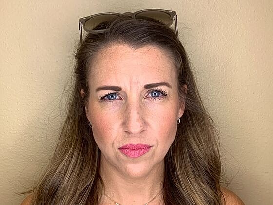 Botox Before & After
