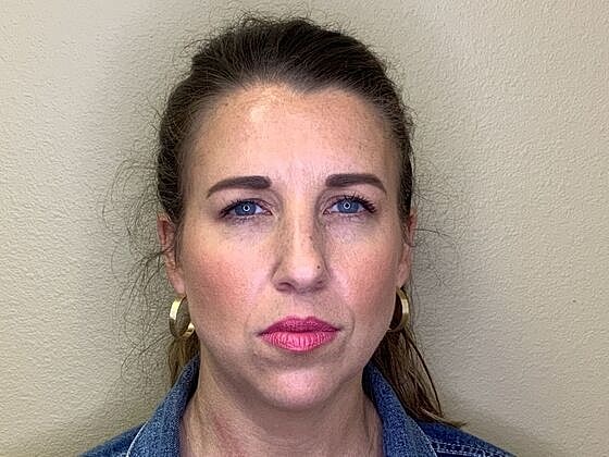 Botox Before & After