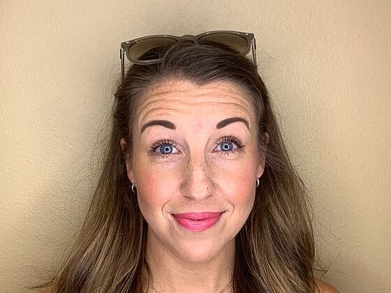 Botox Before & After