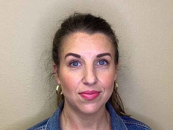Botox Before & After