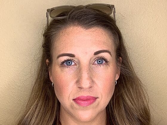 Botox Before & After