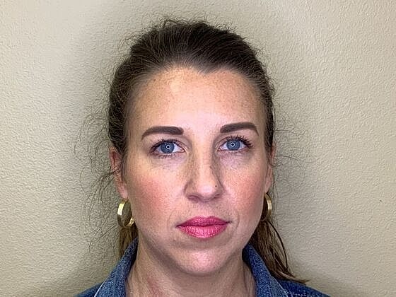 Botox Before & After