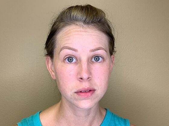 Botox Before & After