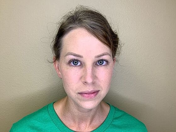 Botox Before & After