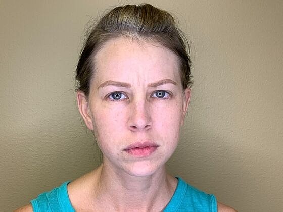 Botox Before & After