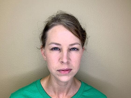 Botox Before & After