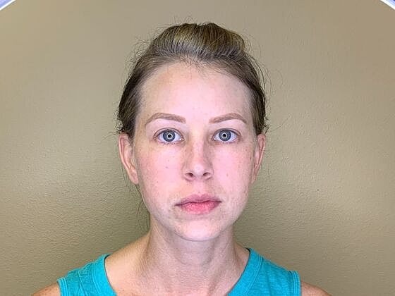 Botox Before & After