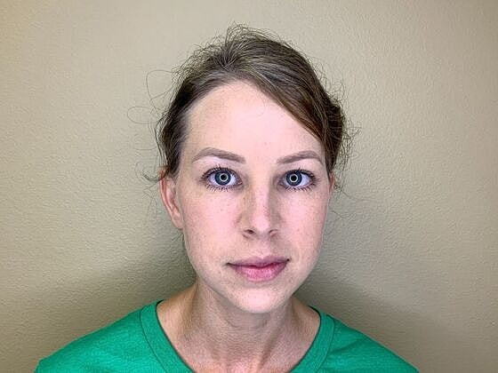 Botox Before & After