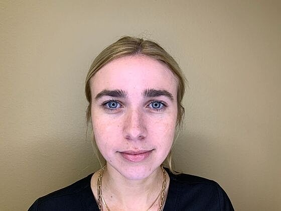 Botox Before & After