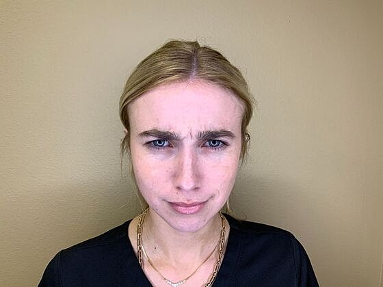 Botox Before & After