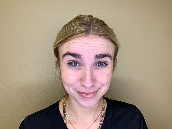 Botox Before & After