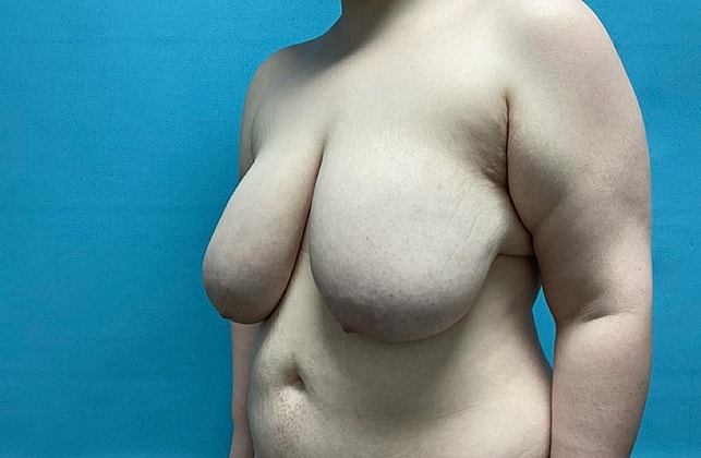 Breast Reduction Before & After