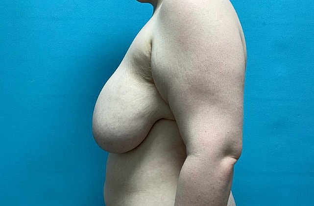 Breast Reduction Before & After