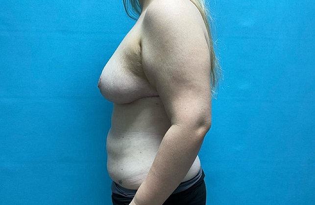 Breast Reduction Before & After