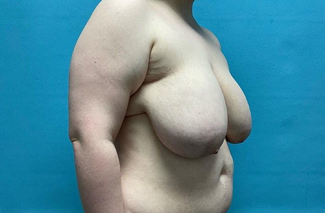 Breast Reduction Before & After