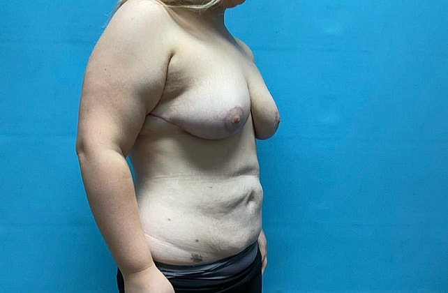 Breast Reduction Before & After