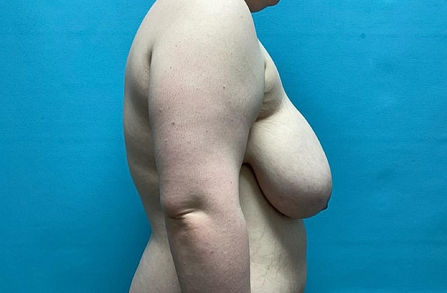 Breast Reduction Before & After